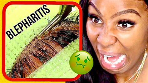 Eyelash Extensions How To Avoid Eyelid Infections Blepharitis Cici Moya Youtube