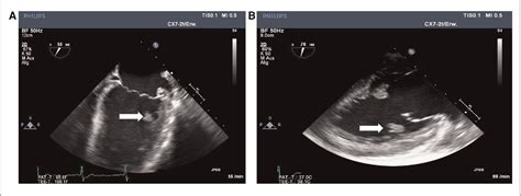 Figure 3 From Splenic Rupture And Fungal Endocarditis In A Pediatric