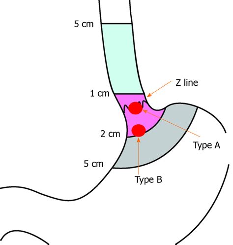 Schematic Diagram Of Esophagogastric Junction Gastrointestinal Stromal