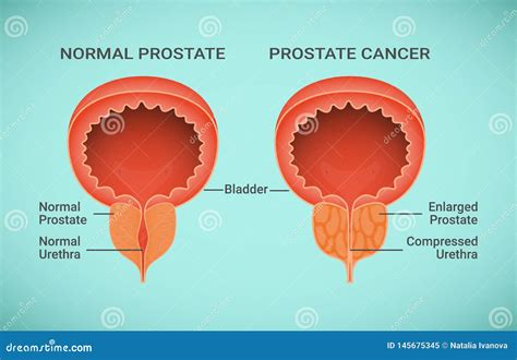 Prostate Cancer Types