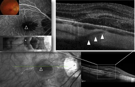 Lacquer Cracks And Perforating Scleral Vessels In Pathologic Myopia A