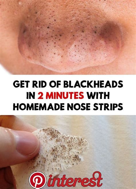 Get Rid Of Blackheads In 2 Minutes With Homemade Nose Strips Get Rid