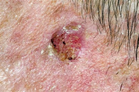 Squamous Cell Skin Cancer Stock Image C Science Photo Library
