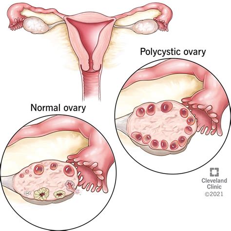 Pcos Polycystic Ovary Syndrome Symptoms And Treatment Flipboard