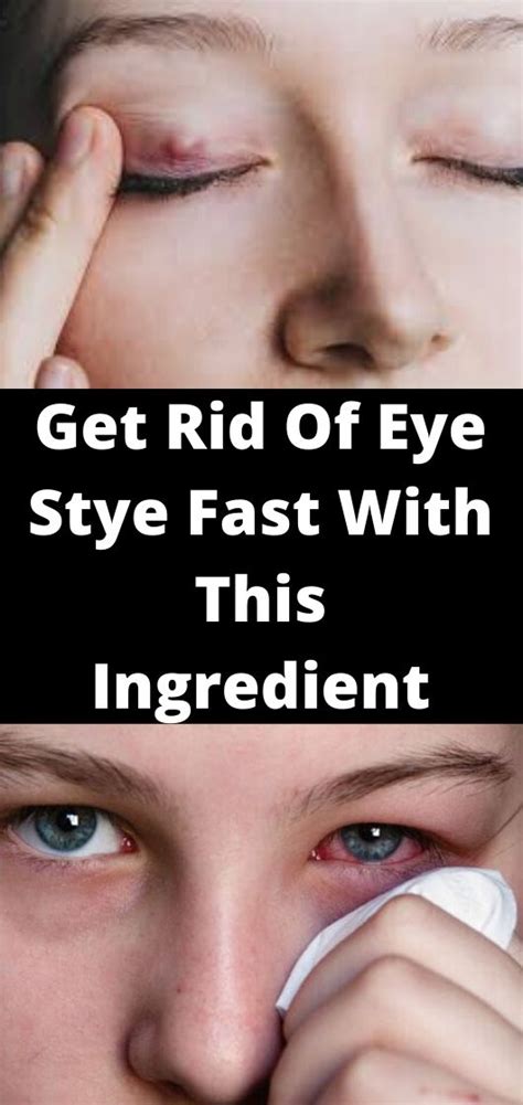 How To Get Rid Of Eye Pimple Eye Stye Remedies Pimples How To Get Rid