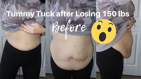 Plastic Surgery After Weight Loss Surgery Tummy Tuck Update Youtube