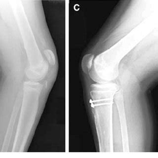 Pdf Tibial Tuberosity Fractures In Adolescents