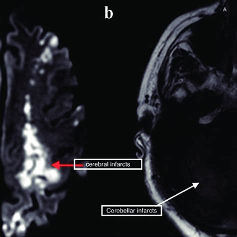 Magnetic Resonance Imaging Of The Brain Showing Bilateral Cerebral A