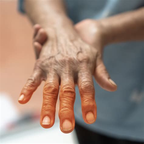 Peripheral Neuropathy Is Common Associated With Diminished Health