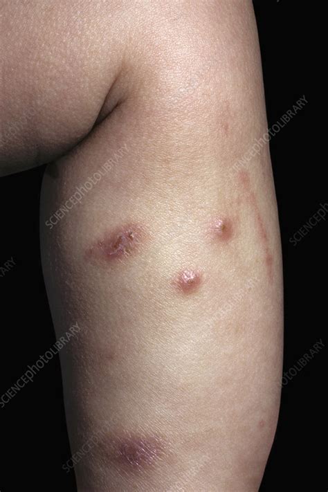 Scabies Infection On The Skin Stock Image C051 5157 Science Photo