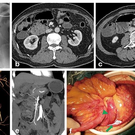 A 64 Year Old Man Developed Volvulus After Radical Resection Of Rectal