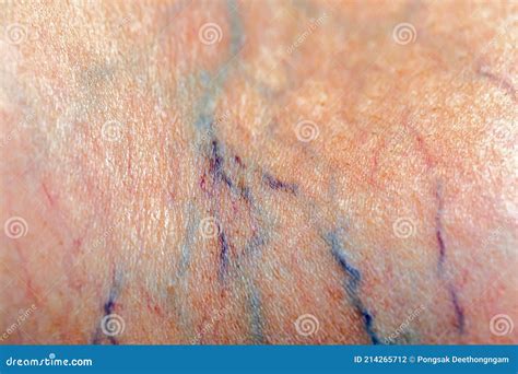Painful Varicose And Spider Veins On Womans Legs Stock Photo Image Of