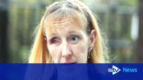 Woman Relives Horror Eye Gouging Attack