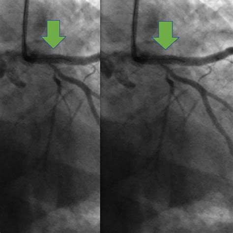 Coronary Angioplasty Or Stenting Central Heart