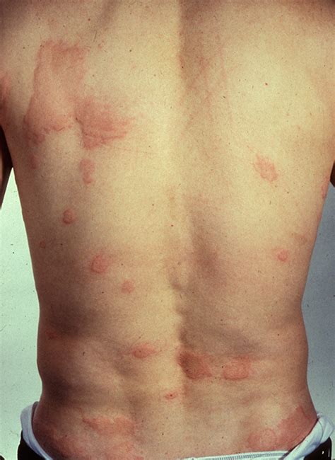 Reasons For Hives In Adults