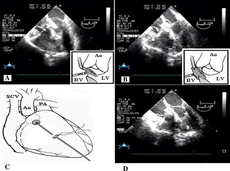 Perventricular Device Closure Of A Large Residual Perimembranous