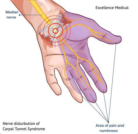 Carpal Tunnel Syndrome Carpal Tunnel Surgery Clinic