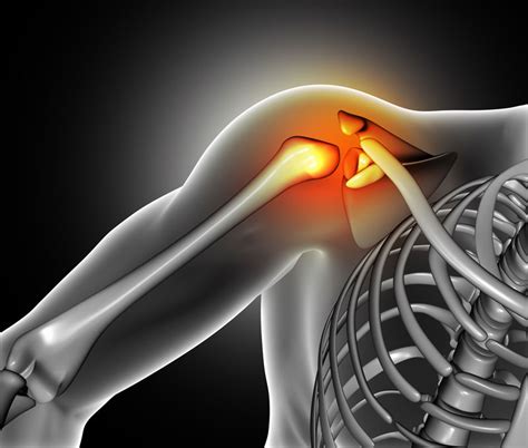 Shoulder Impingement Syndrome Newmarket Physiotherapy