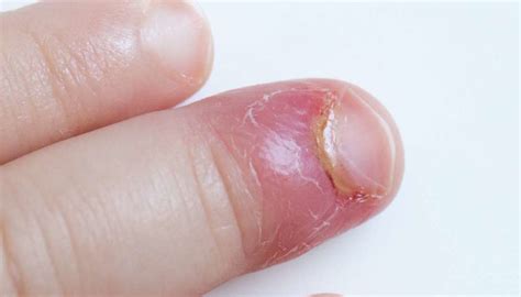 Nails Infections Causes And Preventions Health Gadgetsng
