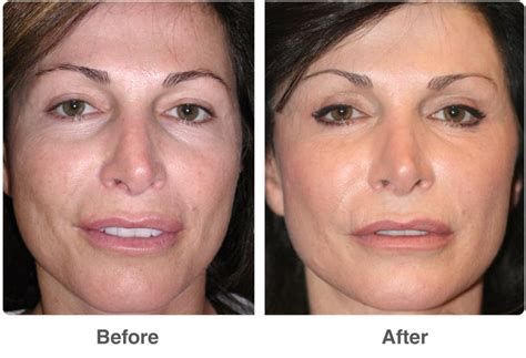 Laser Skin Resurfacing Healing Results