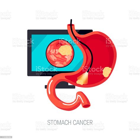 Gastric Cancer Concept In Flat Style Vector Icon Stock Illustration