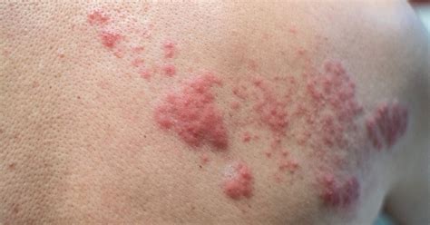 Shingles Qanda Is Shingles Contagious And Everything Else You Need To Know