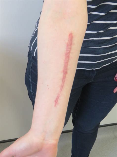 Self Harm Scar Revision Bmj Case Reports