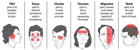 Trigger Point Therapy Treating Tension Headaches Part 3 Headache