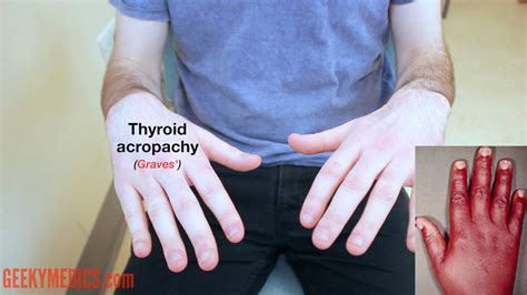 Thyroid Status Examination Osce Guide Geeky Medics