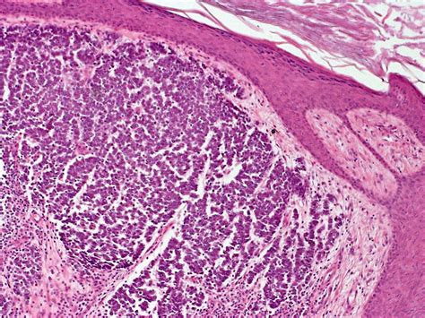 Treatment options for merkel cell carcinoma often depend on whether the cancer has spread beyond the skin. Merkel Cell Carcinoma of Skin