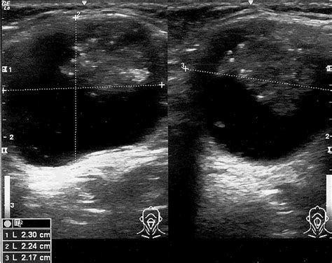Ultrasound Of Thyroglossal Duct Cyst Ultrasound Of The Neck Detected A
