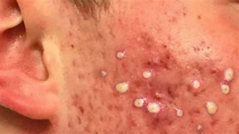 Comedones Blackheads And Pimple Pops Big Popping 101 Youtube