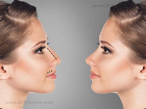 How To Choose Nose Shape Choosing The Right Shape For Your New Nose