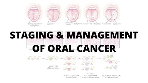 Oral Cancer Staging And Management Surgery Studywithinspiringmindz