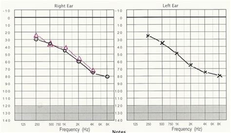 Types Of Deafness Ears And Hearing Uk