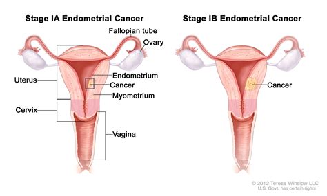 Endometrial Cancer Vanderbilt Ingram Cancer Center