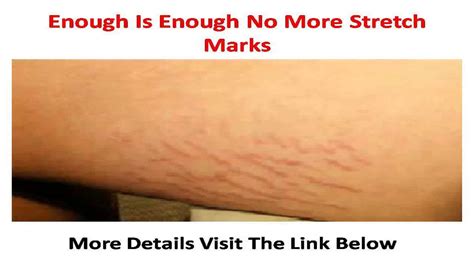 how to hide stretch marks youtube