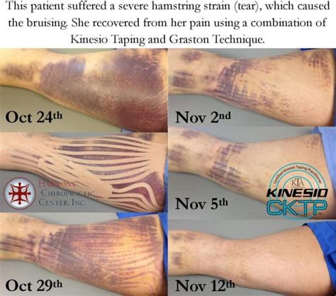 Large Bruise Drained Quickly By Kinesio Tape Harmony Chiropractic