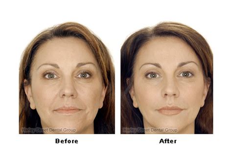 face injections before and after harley street dental group
