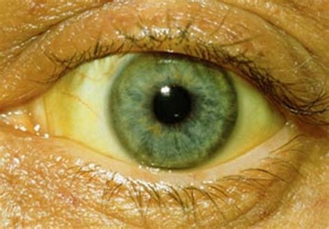 The discharge consists of dead white blood cells, dead viruses or bacteria, and tears. Yellowing of the Eyes - Causes, Treatment, Pictures ...