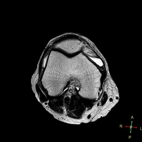 Spontaneous Osteonecrosis Of The Knee Sonk Image