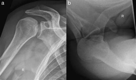 Radiographs Of A Posterior Glenohumeral Dislocation In A Right Shoulder