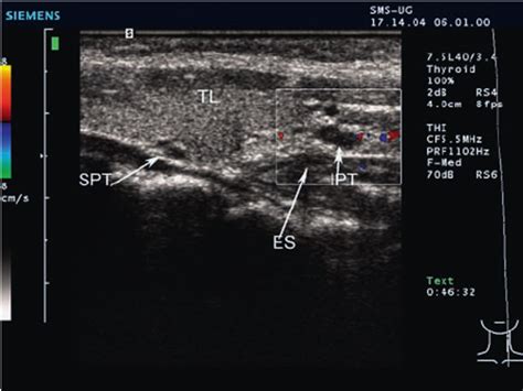 Normal Parathyroid Gland Ultrasound