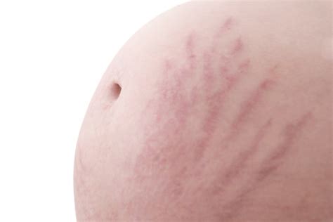 Cellulite Vs Stretch Marks Whats The Difference Rejuviss