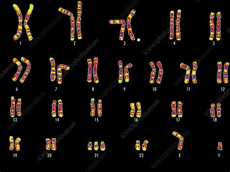 Downs Syndrome Karyotype Stock Image C0018360 Science Photo Library