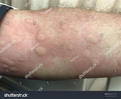 Urticarial Rash Drug Allergy Foto Stock Editar Agora 555776152