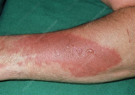 Close Up Second Degree Burn To Male Left Forearm Stock Image M335