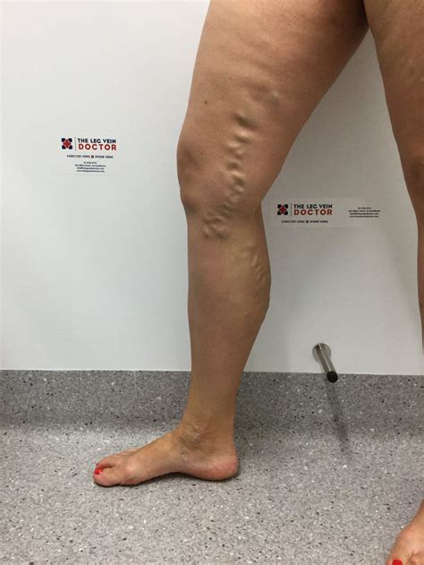 Venous Leg Ulcer — The Leg Vein Doctor Brisbane Varicose And Spider Vein