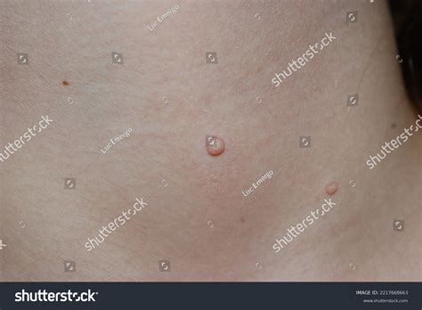Molluscum Contagiosum Water Wart On Skin Stock Photo 2217668663