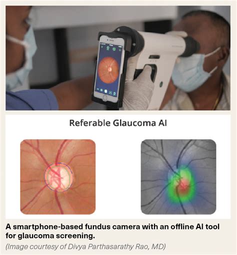 Smartphone Based Fundus Camera Puts Glaucoma Screening In The Palm Of